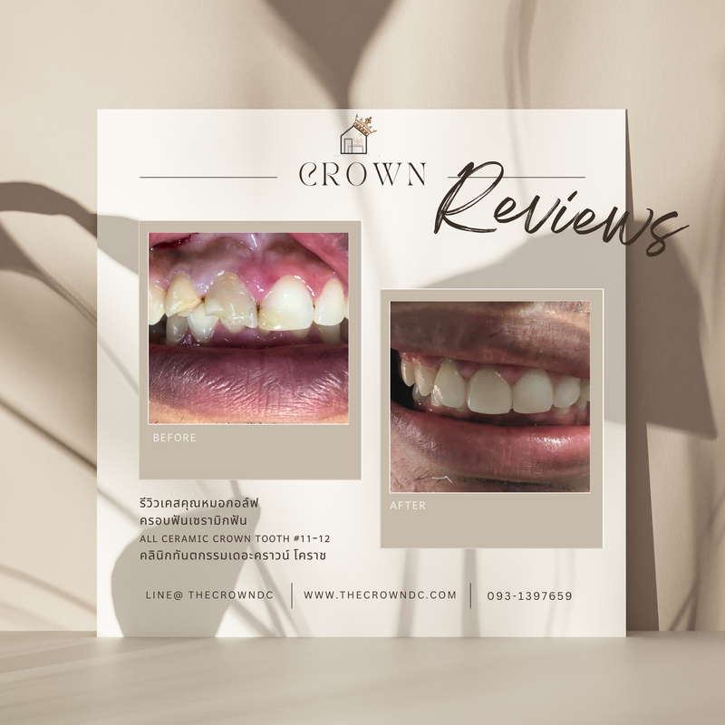 Ceramic crown | ครอบฟันเซรามิก