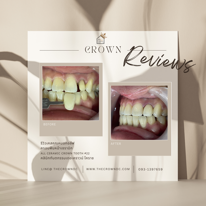 Ceramic crown | ครอบฟันเซรามิก