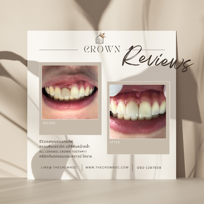 Ceramic crown | ครอบฟันเซรามิก