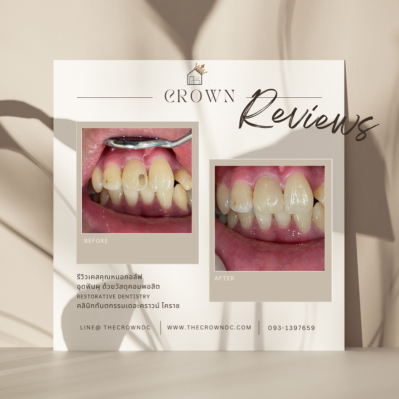 Composite filling | งานอุดฟันคอมพอสิต