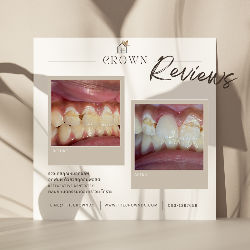 Composite filling | งานอุดฟันคอมพอสิต