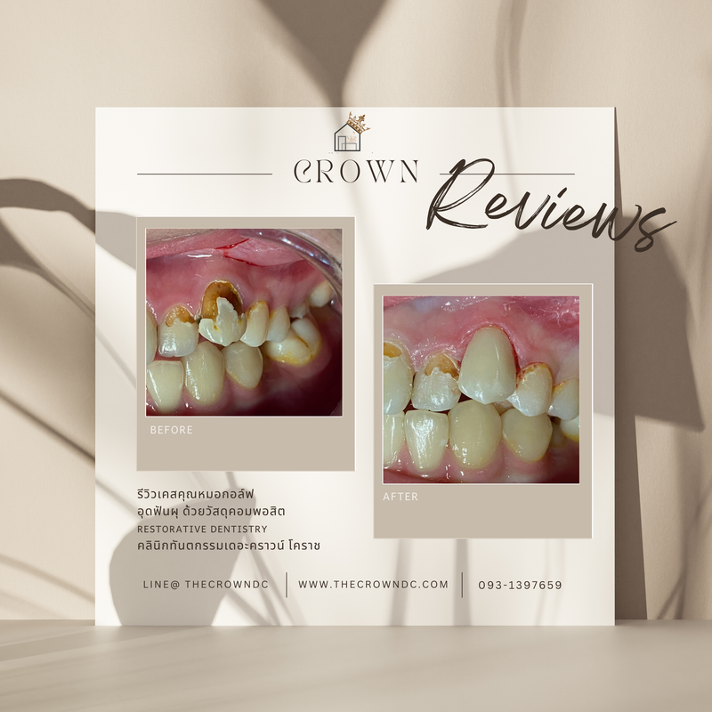 Composite filling | งานอุดฟันคอมพอสิต