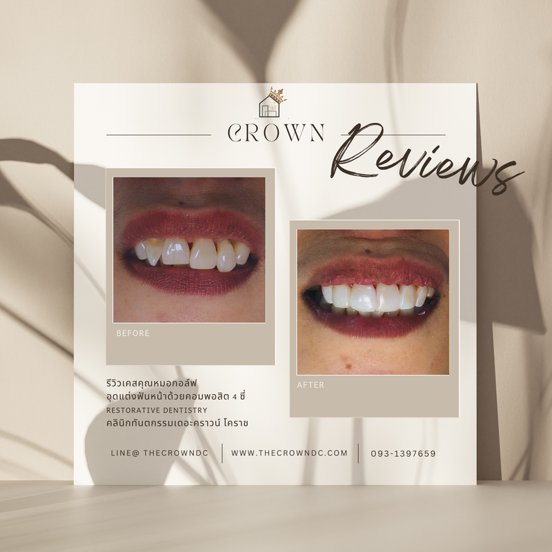 Composite filling | งานอุดฟันคอมพอสิต