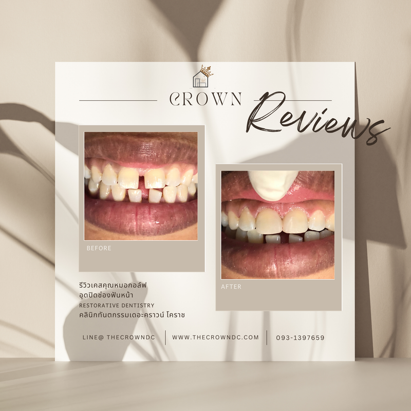 Composite filling | งานอุดฟันคอมพอสิต