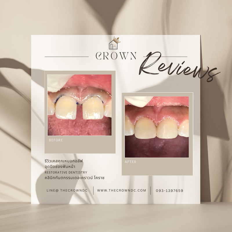 Composite filling | งานอุดฟันคอมพอสิต