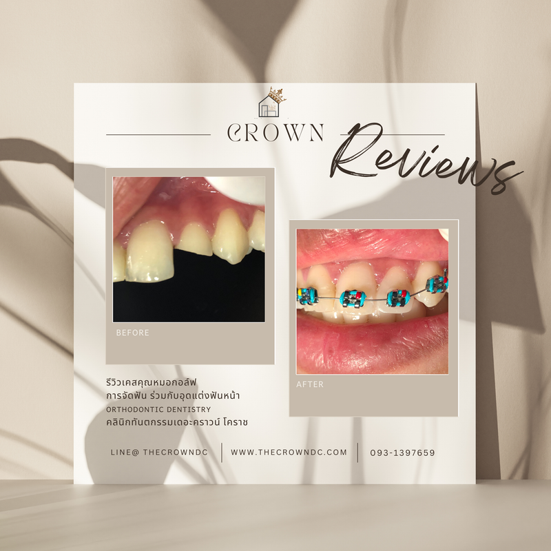 Composite filling | งานอุดฟันคอมพอสิต