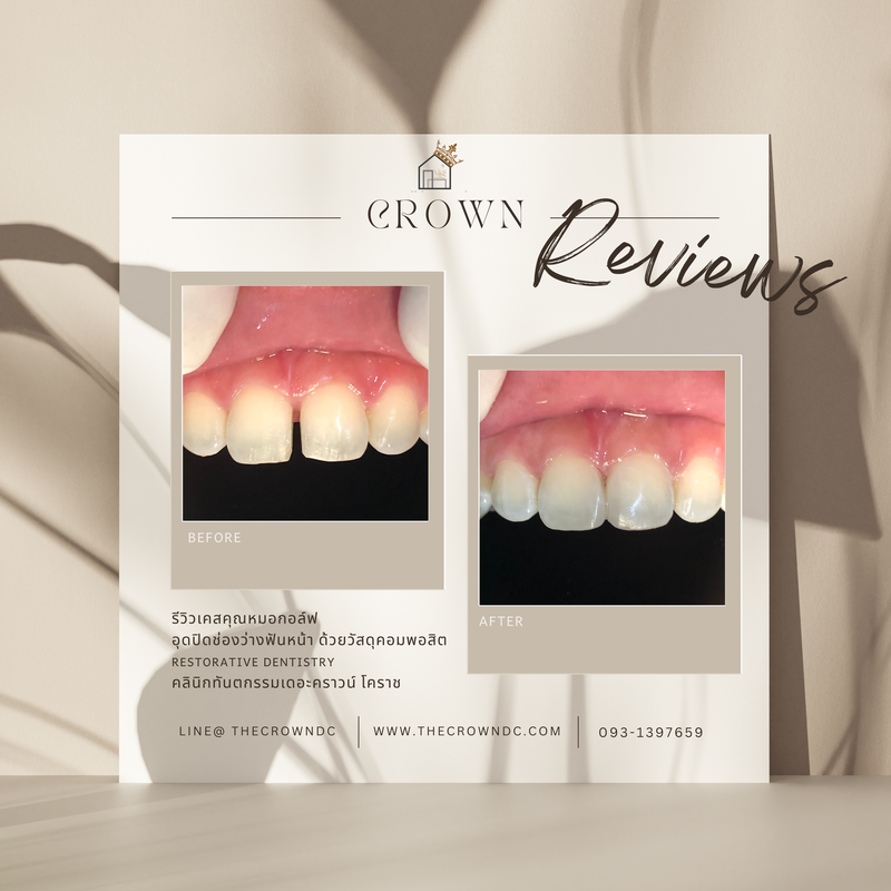 Composite filling | งานอุดฟันคอมพอสิต