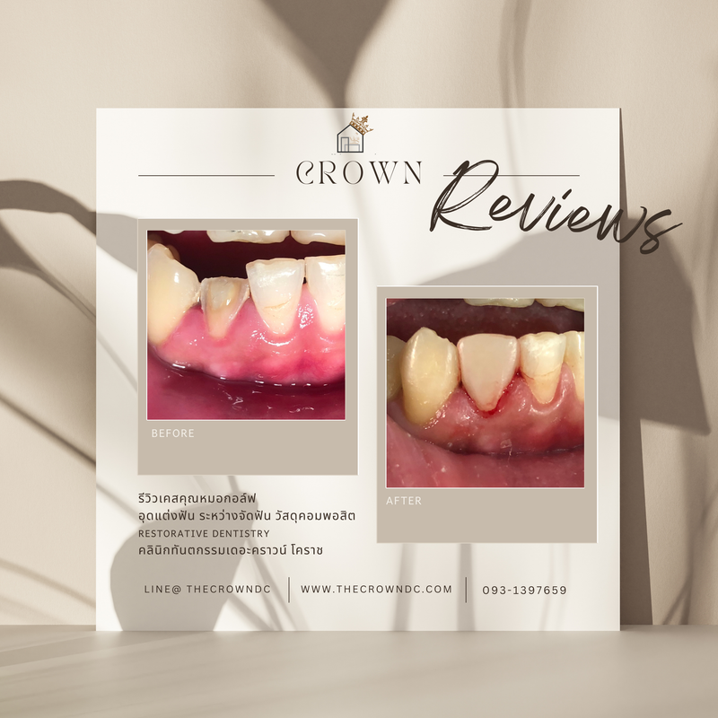 Composite filling | งานอุดฟันคอมพอสิต