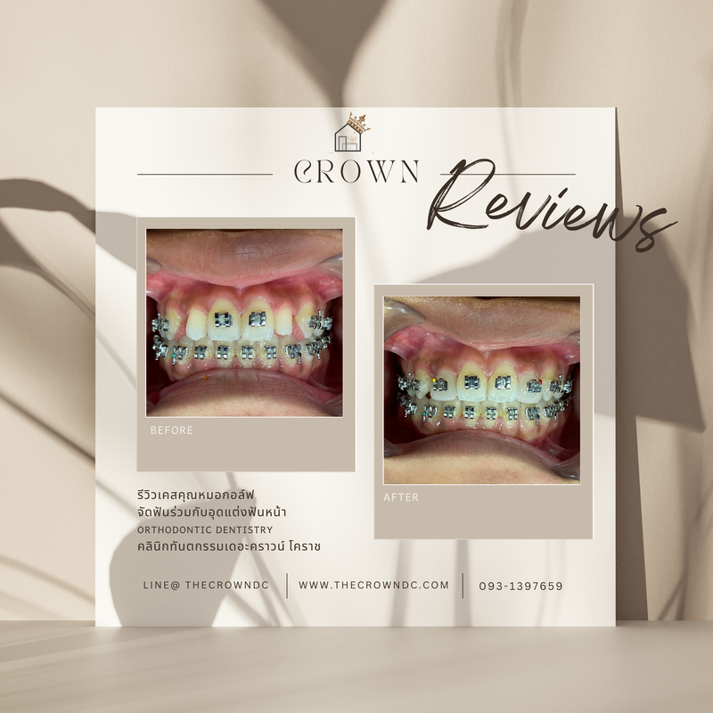 Composite filling | งานอุดฟันคอมพอสิต