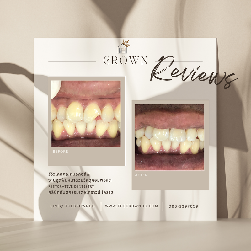 Composite filling | งานอุดฟันคอมพอสิต