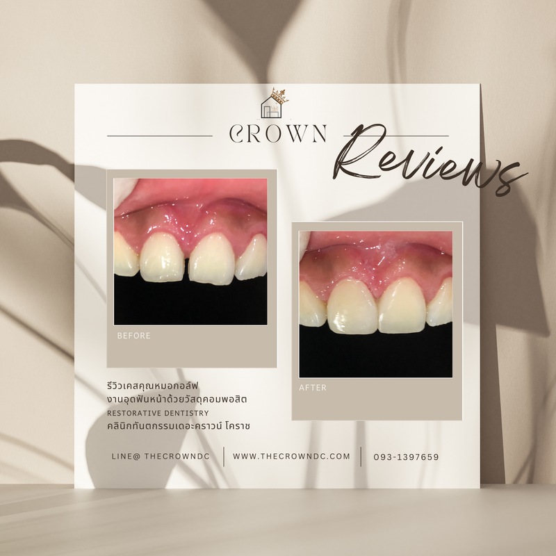 Composite filling | งานอุดฟันคอมพอสิต