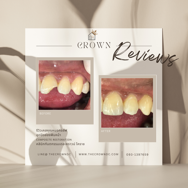 Composite filling | งานอุดฟันคอมพอสิต