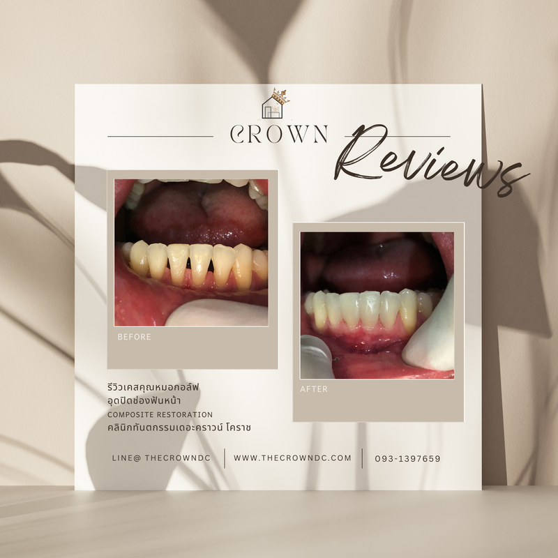 Composite filling | งานอุดฟันคอมพอสิต