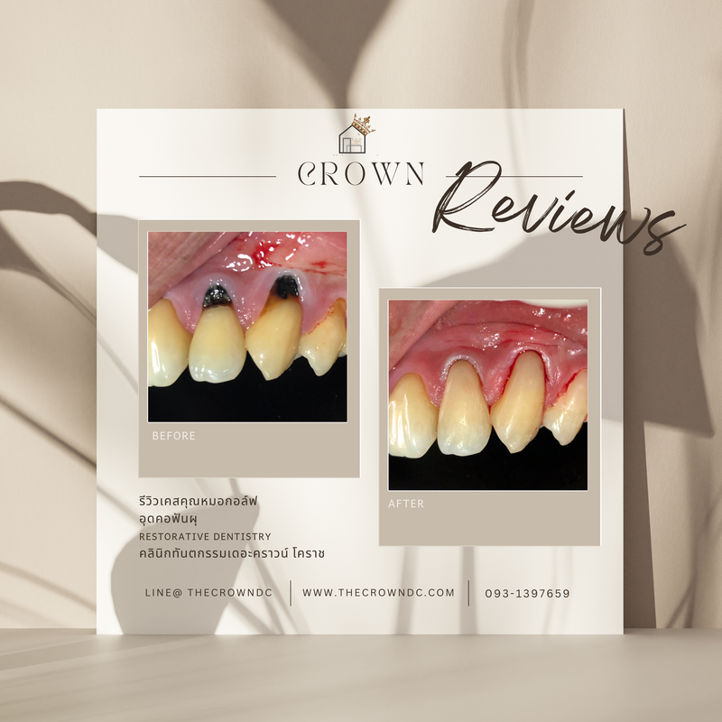 Composite filling | งานอุดฟันคอมพอสิต