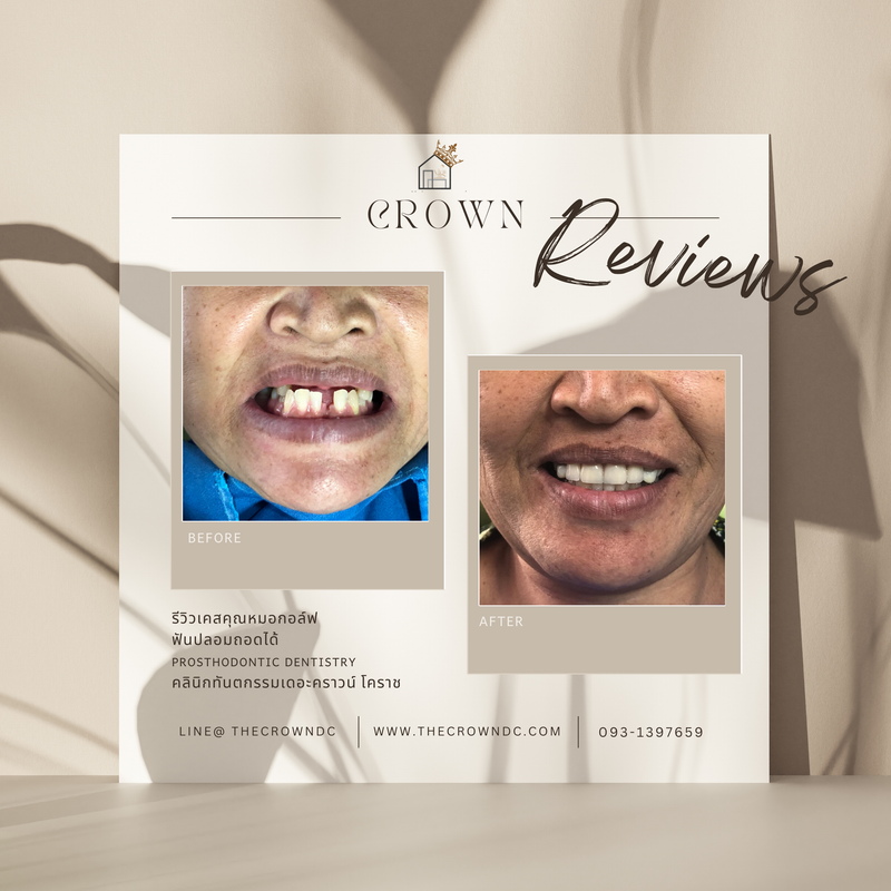 Removable prosthesis | ฟันปลอมถอดได้