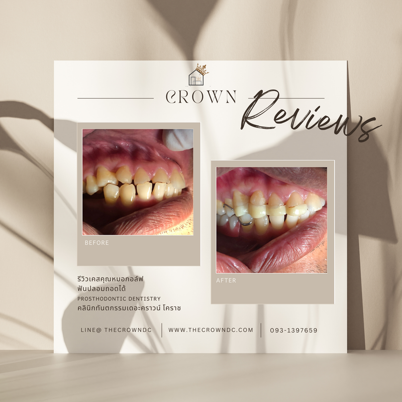 Removable prosthesis | ฟันปลอมถอดได้