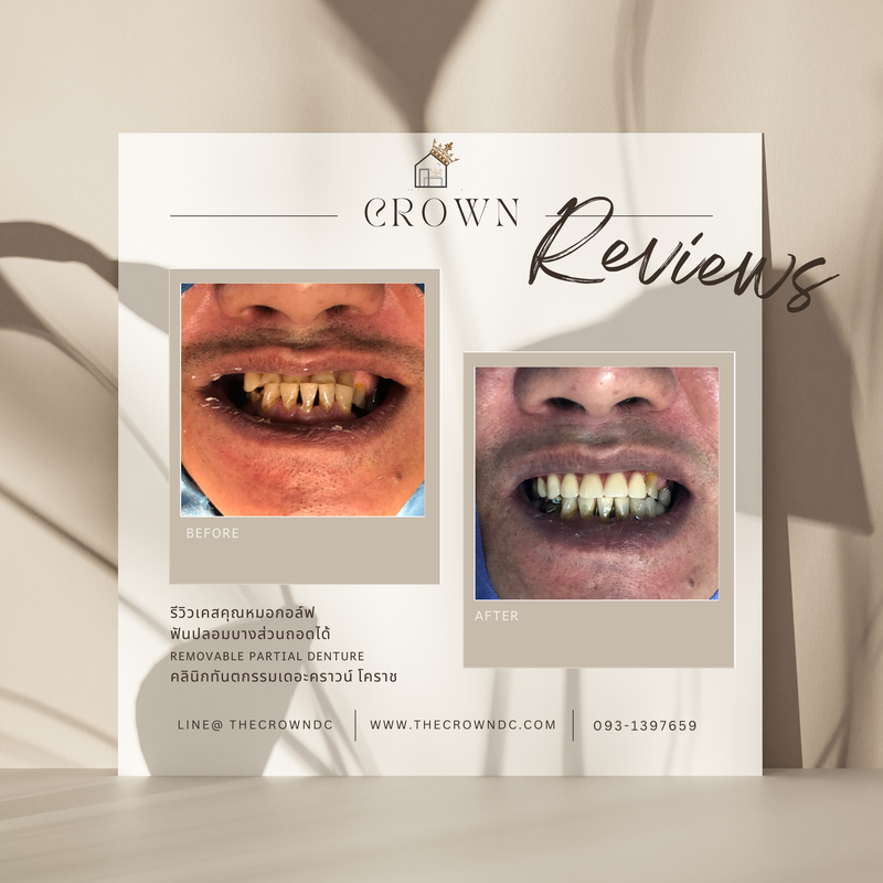 Removable prosthesis | ฟันปลอมถอดได้