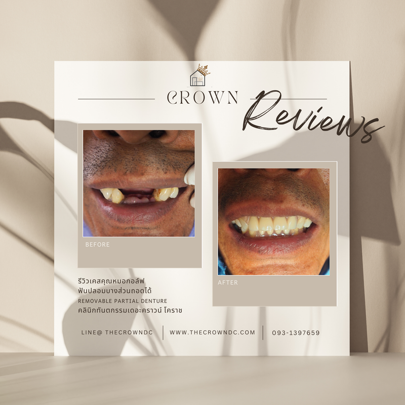 Removable prosthesis | ฟันปลอมถอดได้