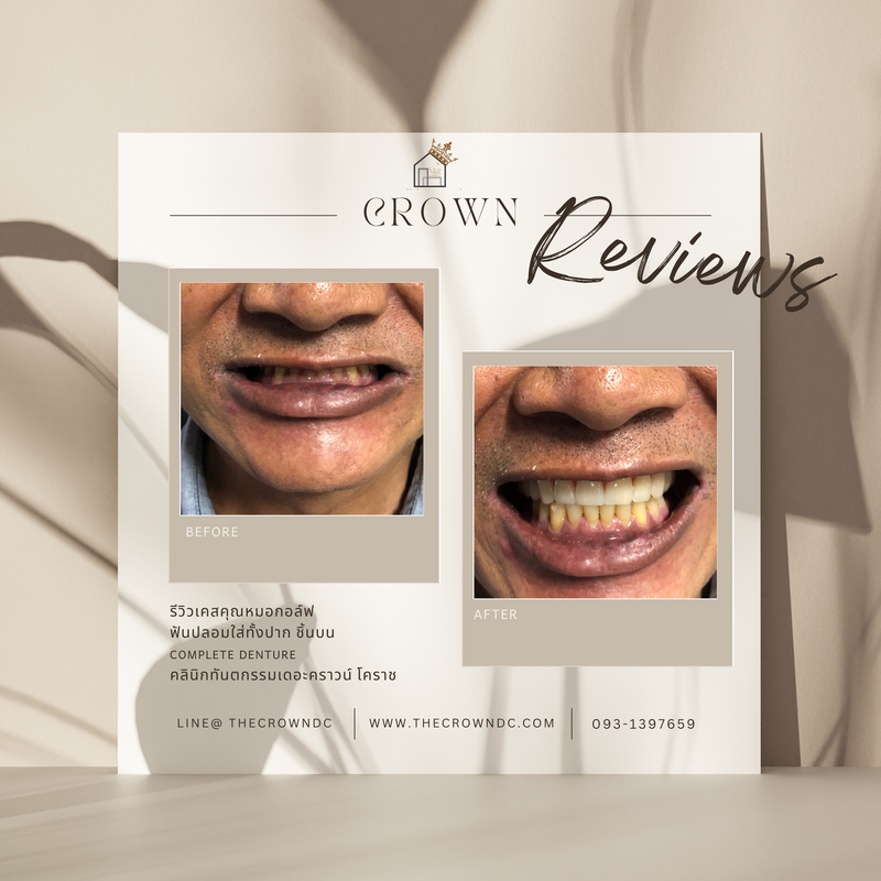 Removable prosthesis | ฟันปลอมถอดได้