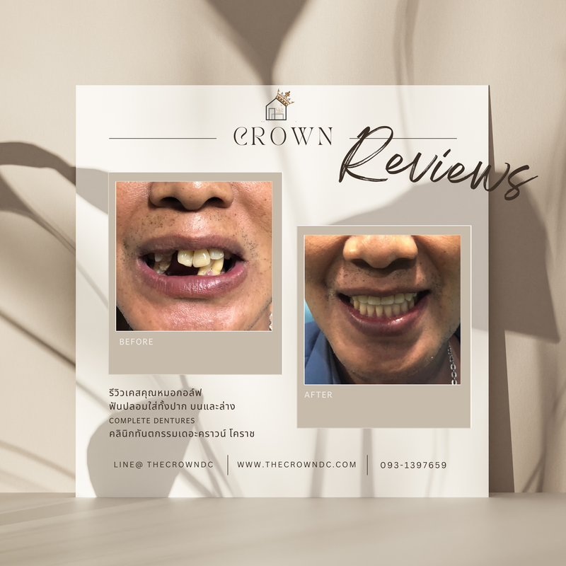 Removable prosthesis | ฟันปลอมถอดได้