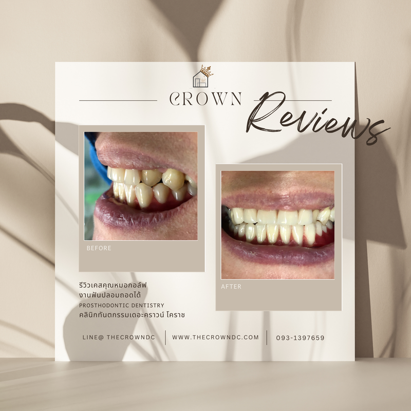 Removable prosthesis | ฟันปลอมถอดได้