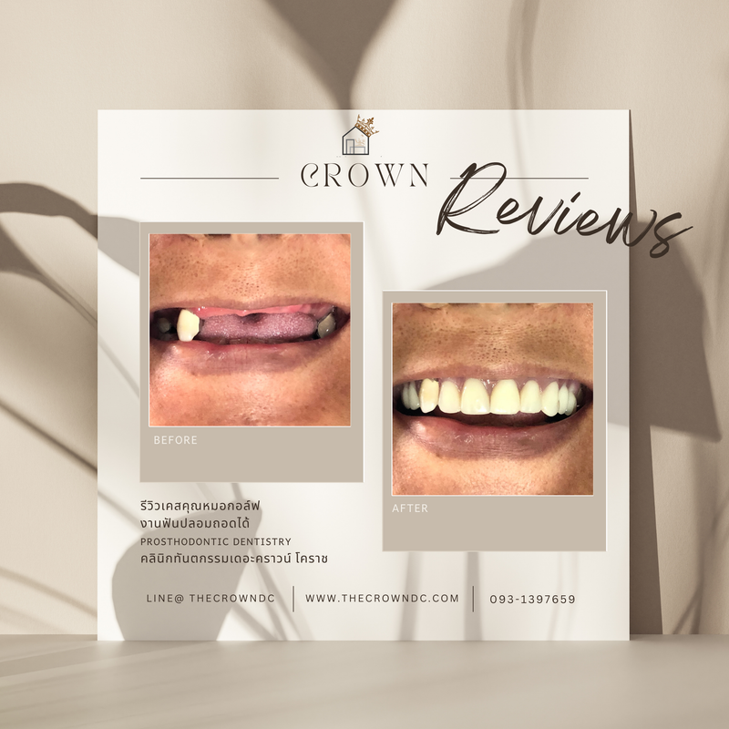 Removable prosthesis | ฟันปลอมถอดได้