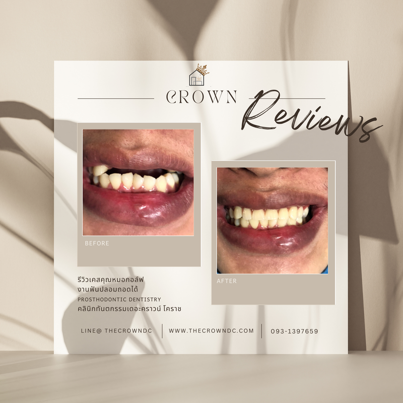 Removable prosthesis | ฟันปลอมถอดได้