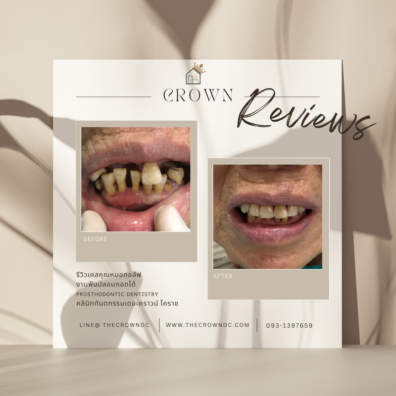 Removable prosthesis | ฟันปลอมถอดได้