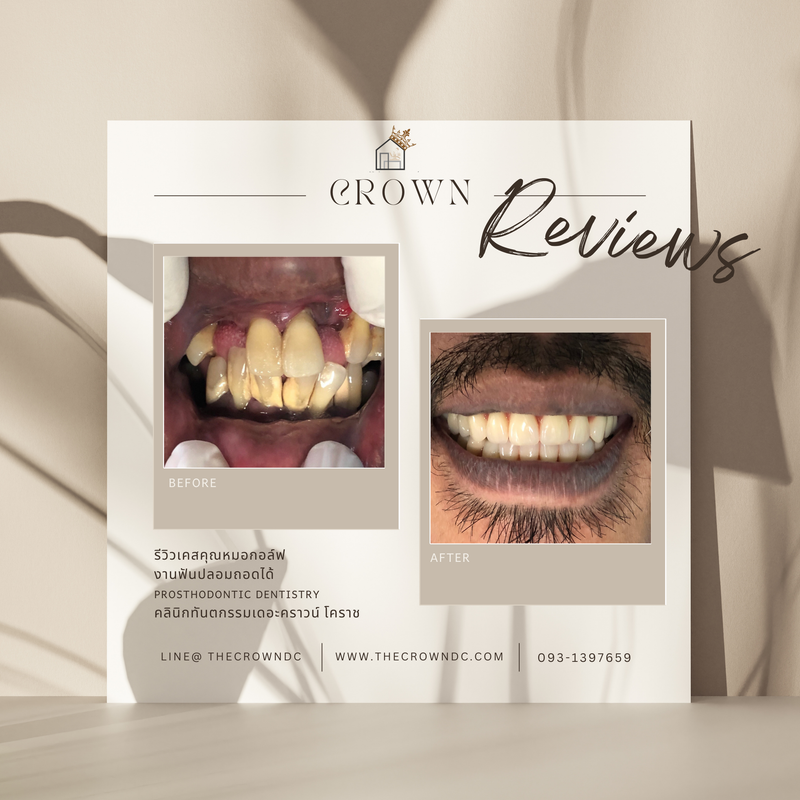 Removable prosthesis | ฟันปลอมถอดได้