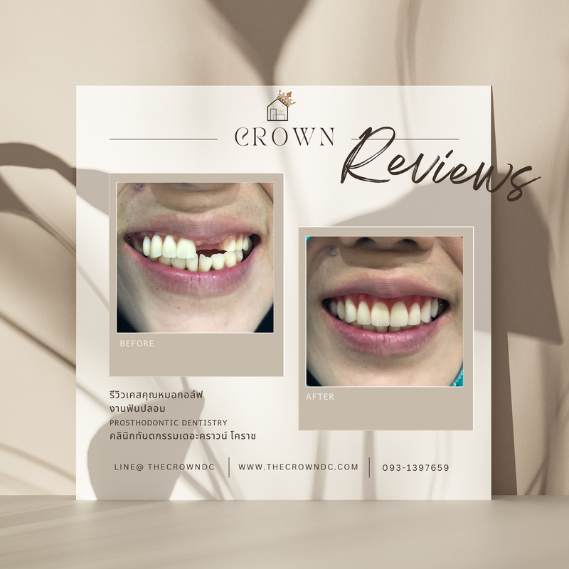 Removable prosthesis | ฟันปลอมถอดได้