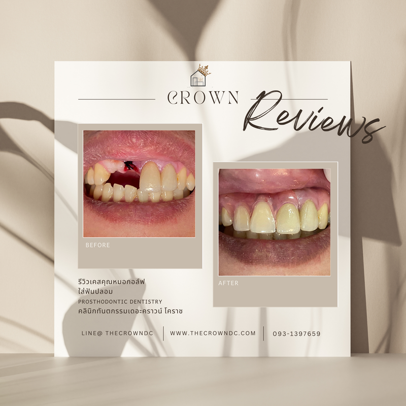 Removable prosthesis | ฟันปลอมถอดได้