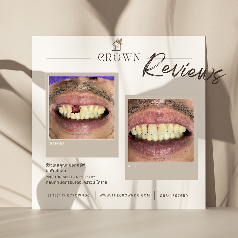 Removable prosthesis | ฟันปลอมถอดได้