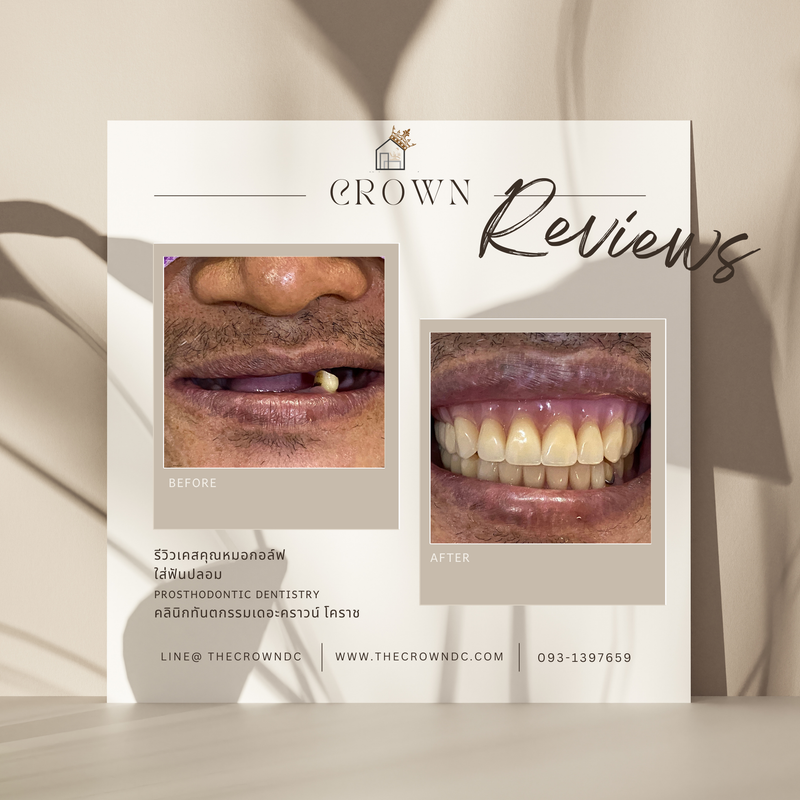 Removable prosthesis | ฟันปลอมถอดได้