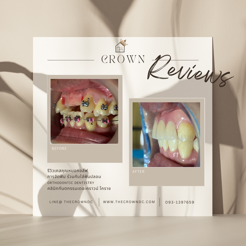 Removable prosthesis | ฟันปลอมถอดได้