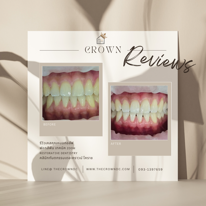 In-office bleaching I ฟอกสีฟัน