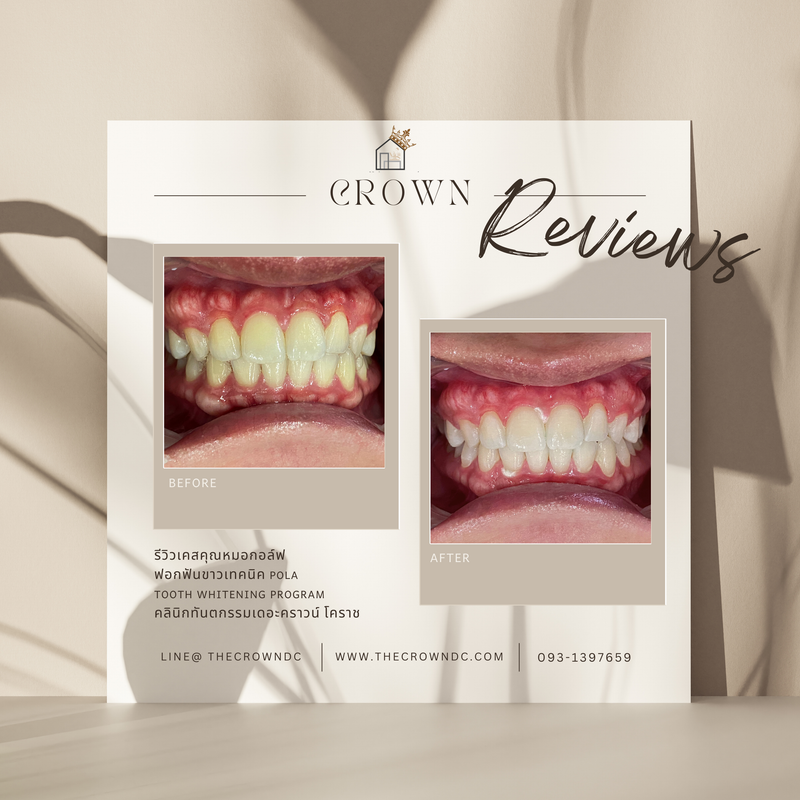 In-office bleaching I ฟอกสีฟัน