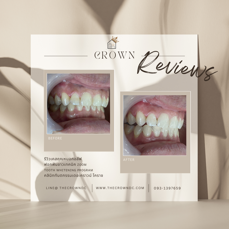 In-office bleaching I ฟอกสีฟัน