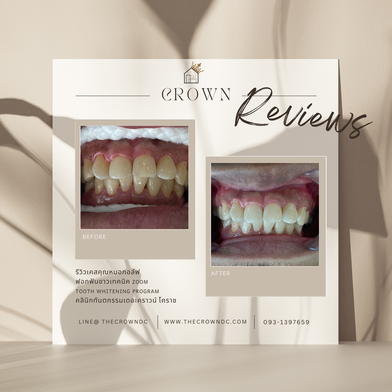 In-office bleaching I ฟอกสีฟัน