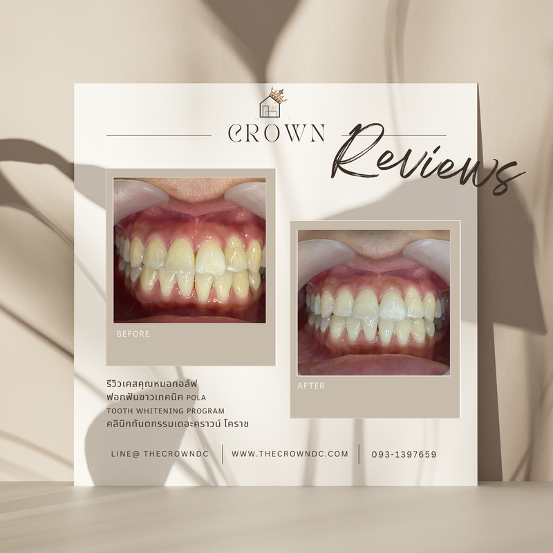 In-office bleaching I ฟอกสีฟัน