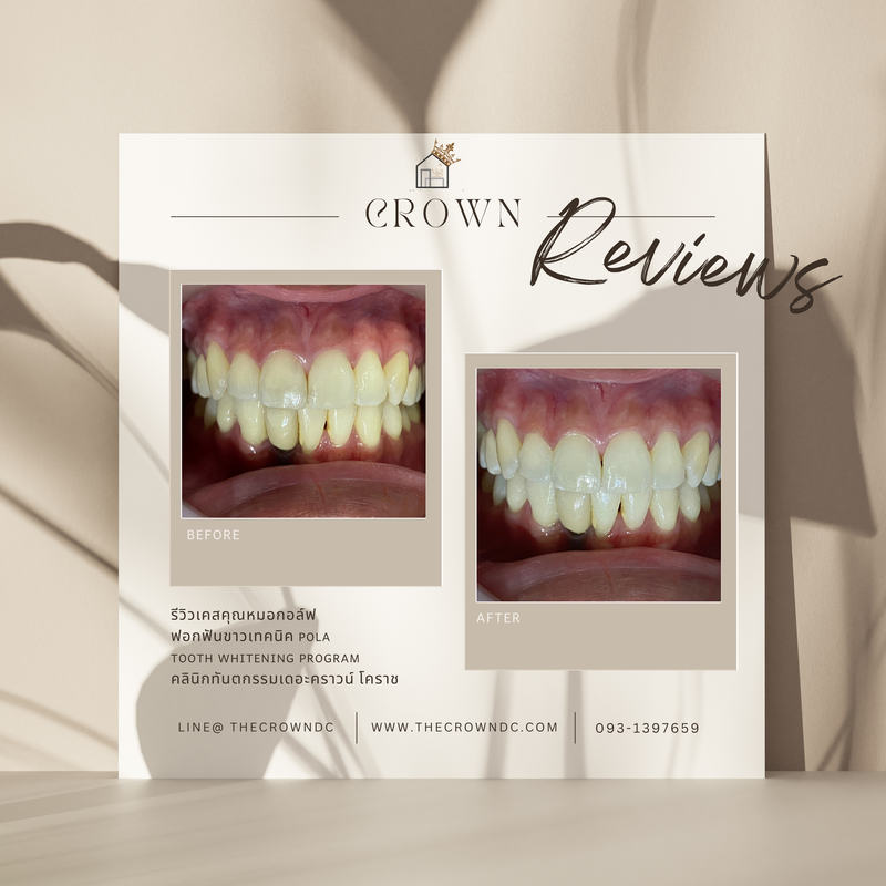 In-office bleaching I ฟอกสีฟัน