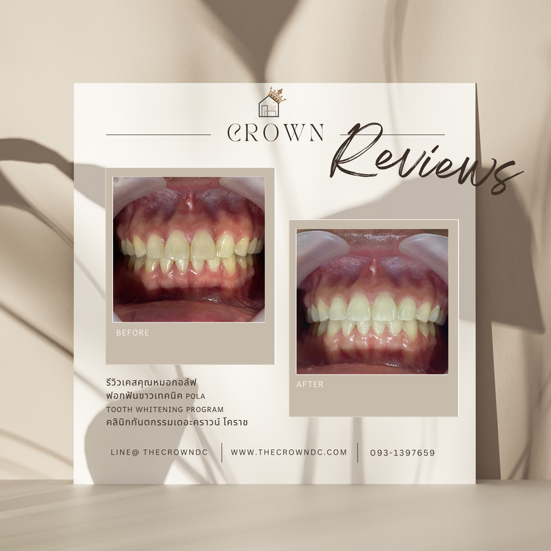 In-office bleaching I ฟอกสีฟัน