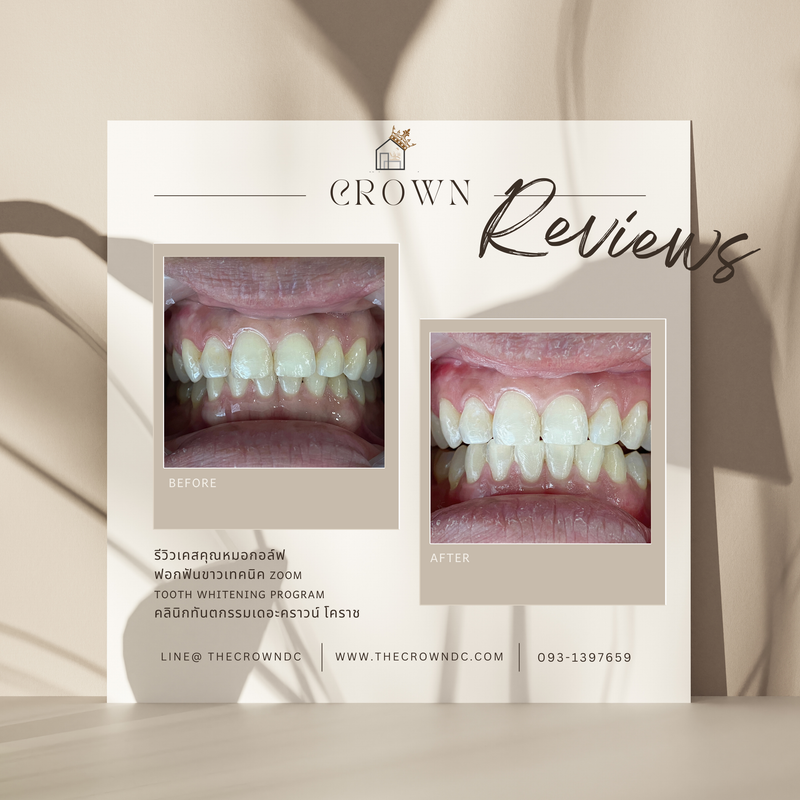 In-office bleaching I ฟอกสีฟัน