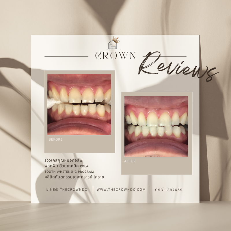 In-office bleaching I ฟอกสีฟัน