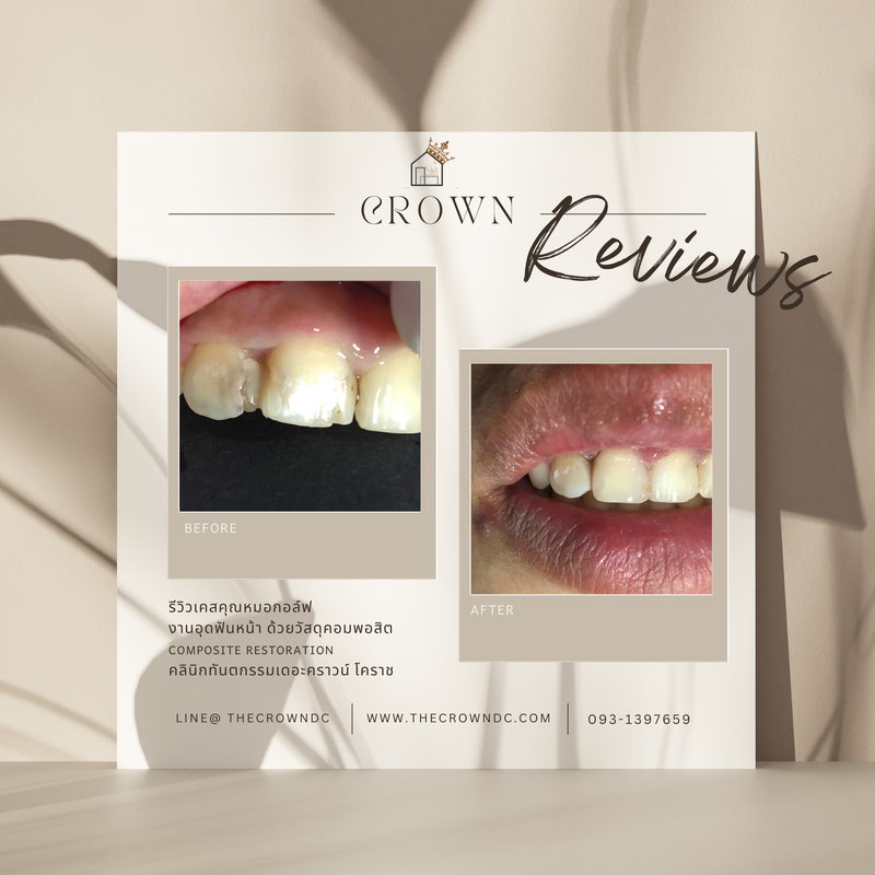 Composite filling | งานอุดฟันคอมพอสิต