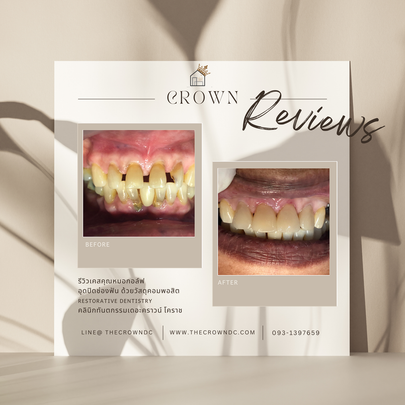 Composite filling | งานอุดฟันคอมพอสิต