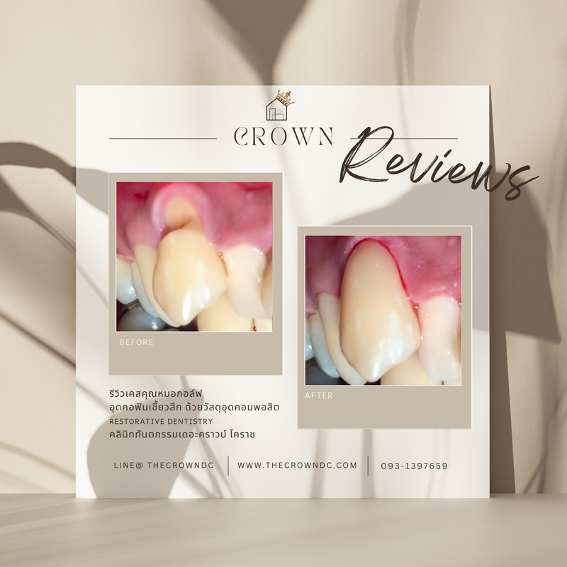 Composite filling | งานอุดฟันคอมพอสิต