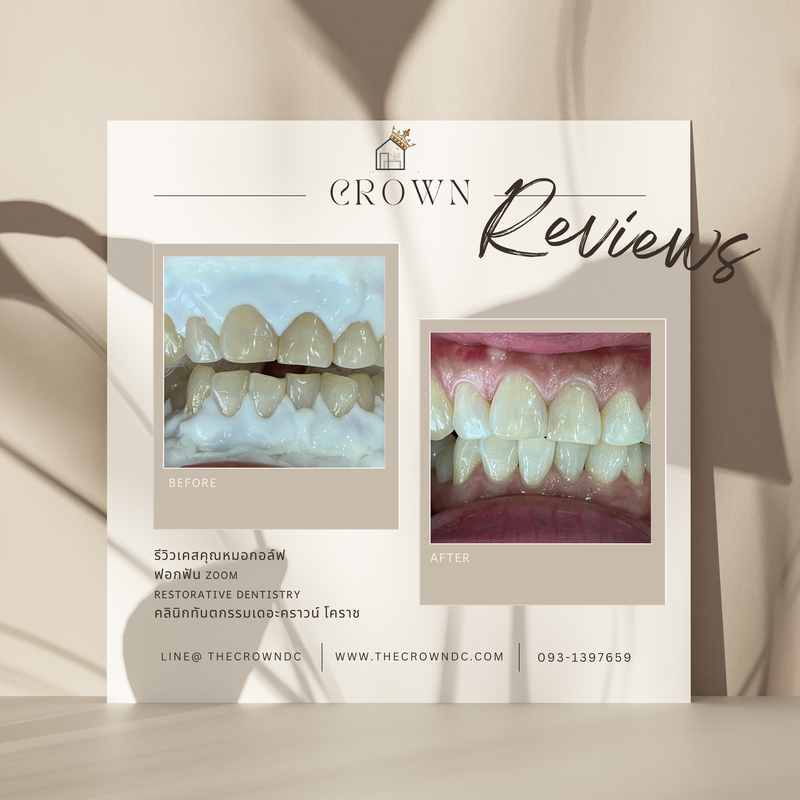 In-office bleaching I ฟอกสีฟัน