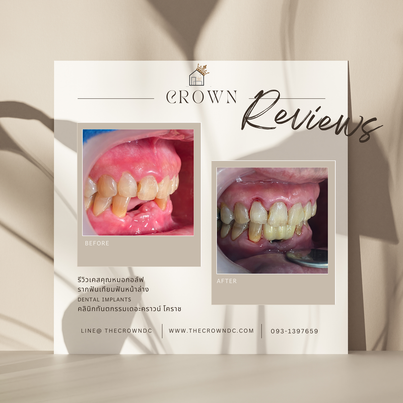 Dental implant l งานรากฟันเทียม 