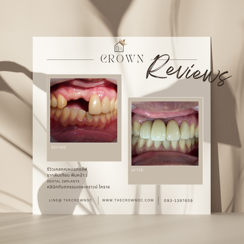 Dental implant l งานรากฟันเทียม 