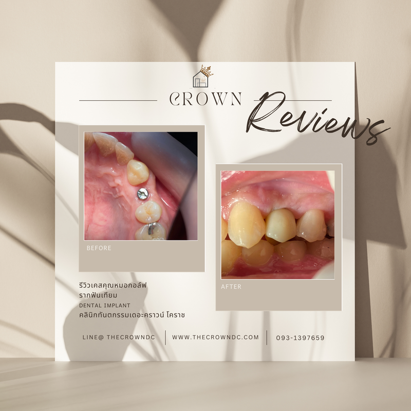 Dental implant l งานรากฟันเทียม 